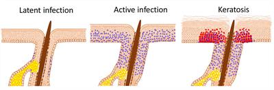 HPV-Induced Field Cancerisation: Transformation of Adult Tissue Stem Cell Into Cancer Stem Cell